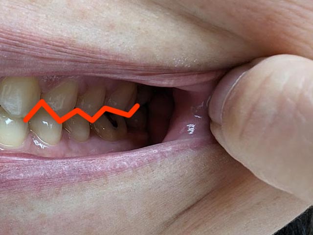 奥歯のギザギザライン